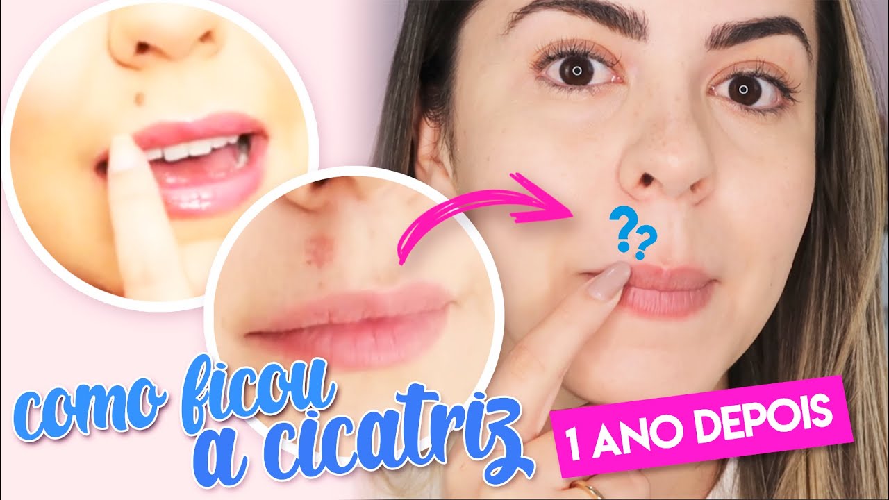 REMOÇÃO DE PINTA - Como ficou a CICATRIZ 1 ANO depois | Carol Ramos