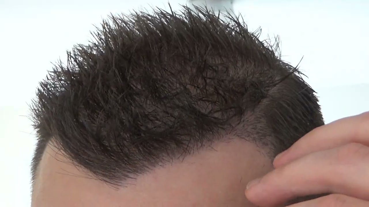 Week 35 (Day 249) FUE Hair Transplant & PRP: Post Op Recovery - Day 138 No Shampoo