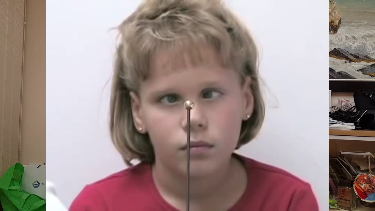 Глазодвижения. Лекция №3: Межъядерная офтальмоплегия