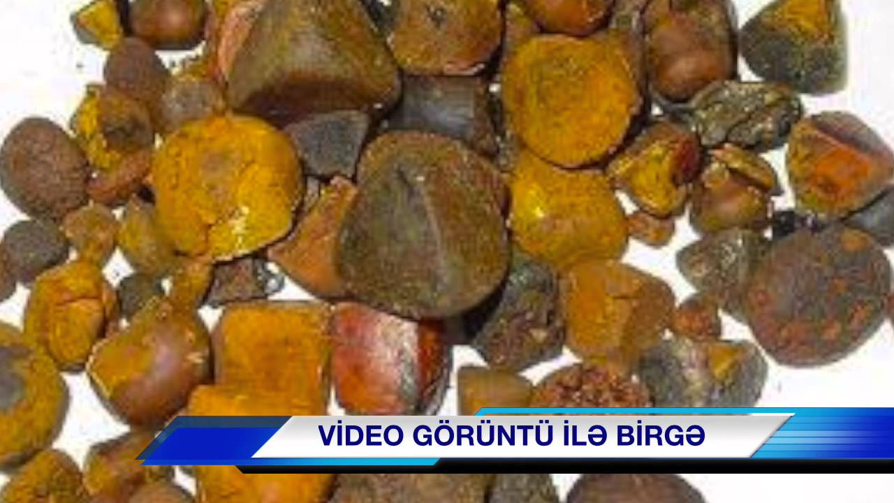 Od dashi xestgeliyi,&Ouml;d daşı xəstəliyi,&Ouml;d daşları