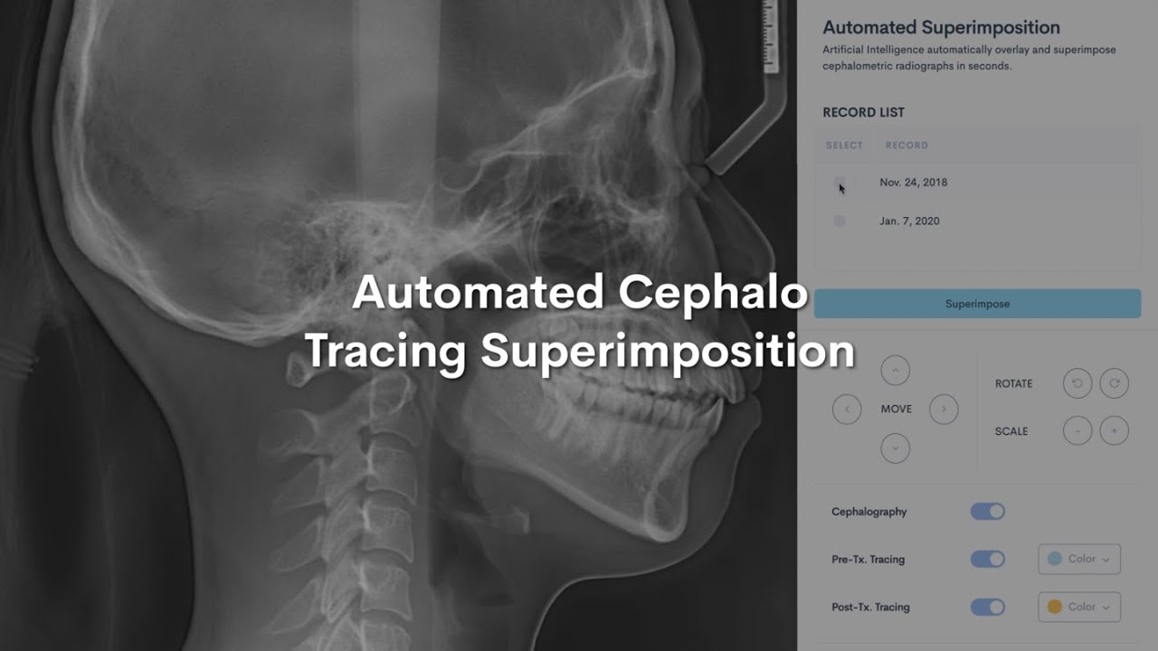 WebCeph: Automated Cephalo Tracing Superimposition