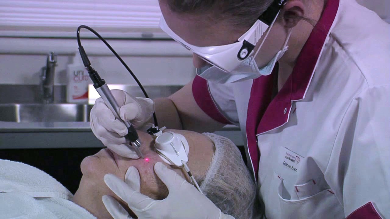 verwijderen van couperose, rode adertjes, ouderdomsvlekken en steelwratjes