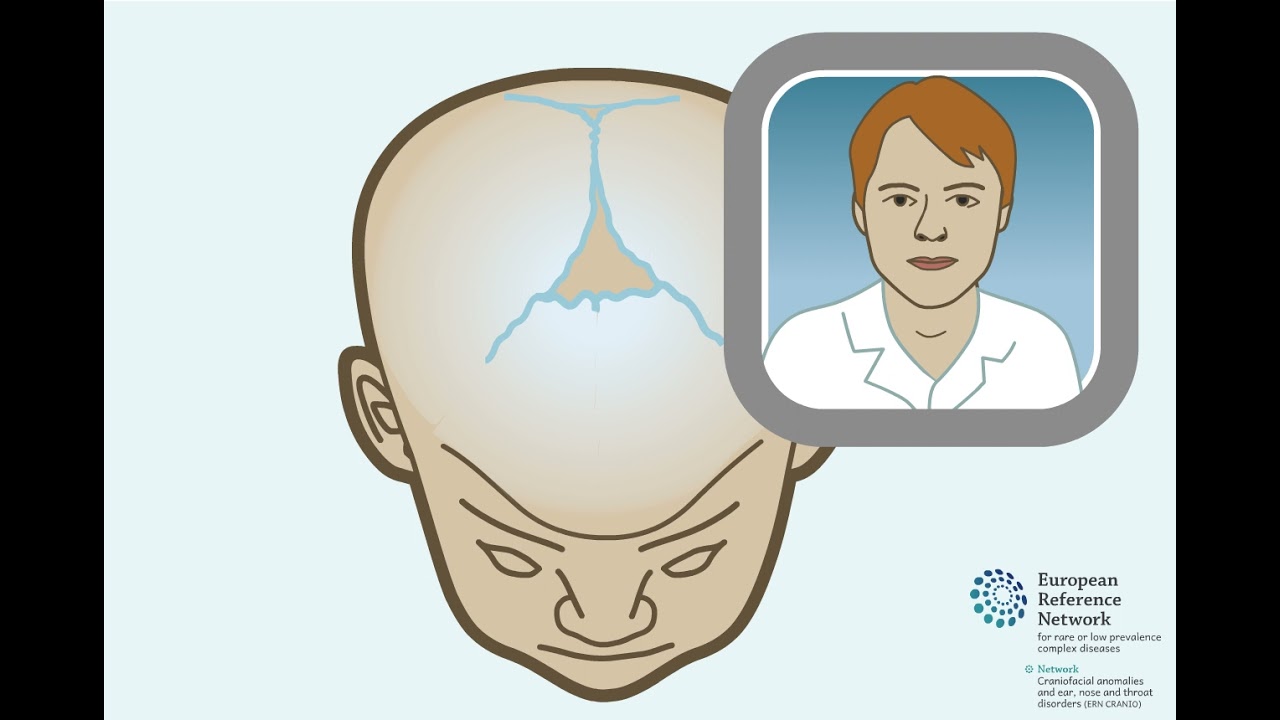 Endoscopically assisted suturectomy for trigonocephaly