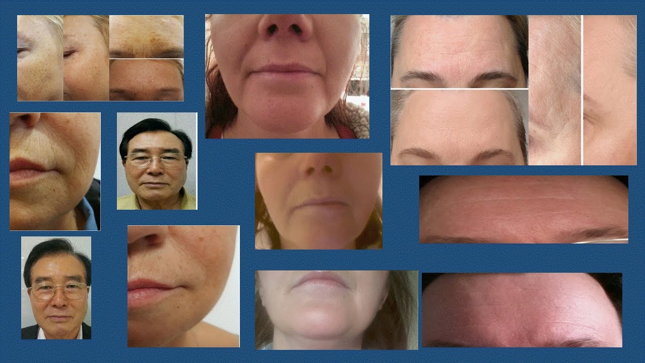 See, what LAMIDERM  can do for you ...