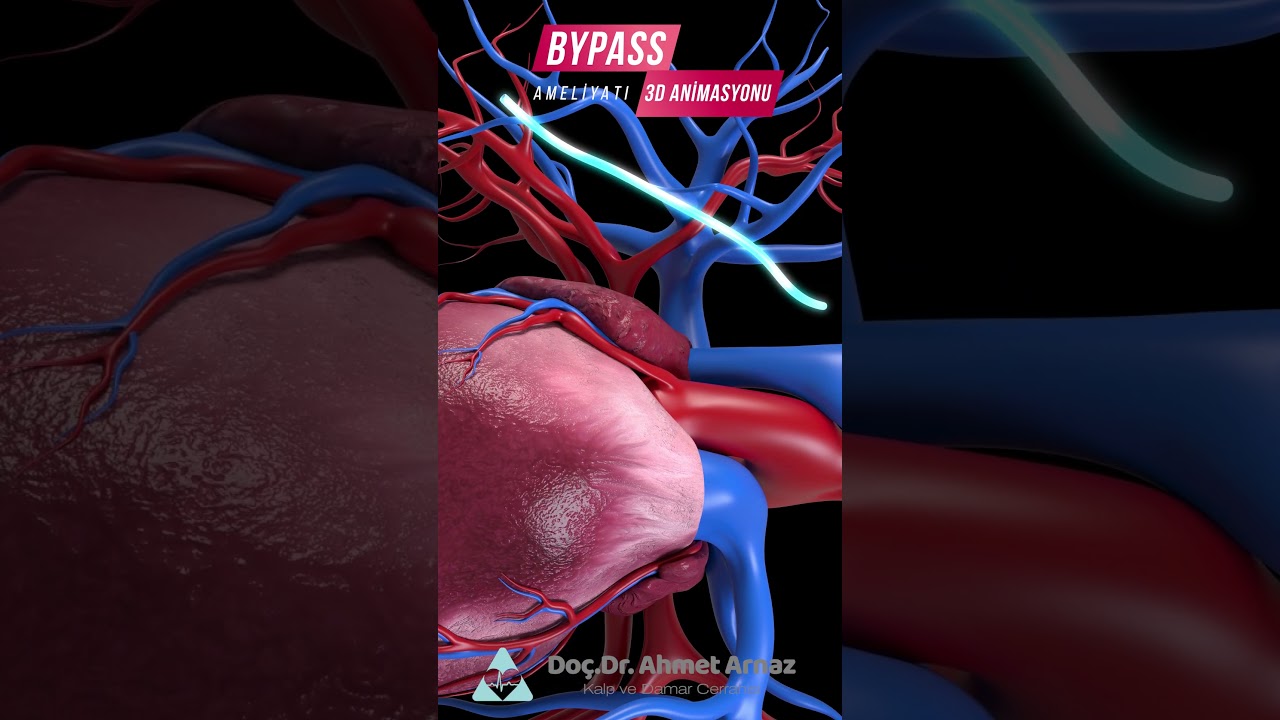 ByPass Ameliyatı 3D Animasyonu #bypass #kalpcerrahi #kapalıbaypass #shorts  #t&uuml;rkiye