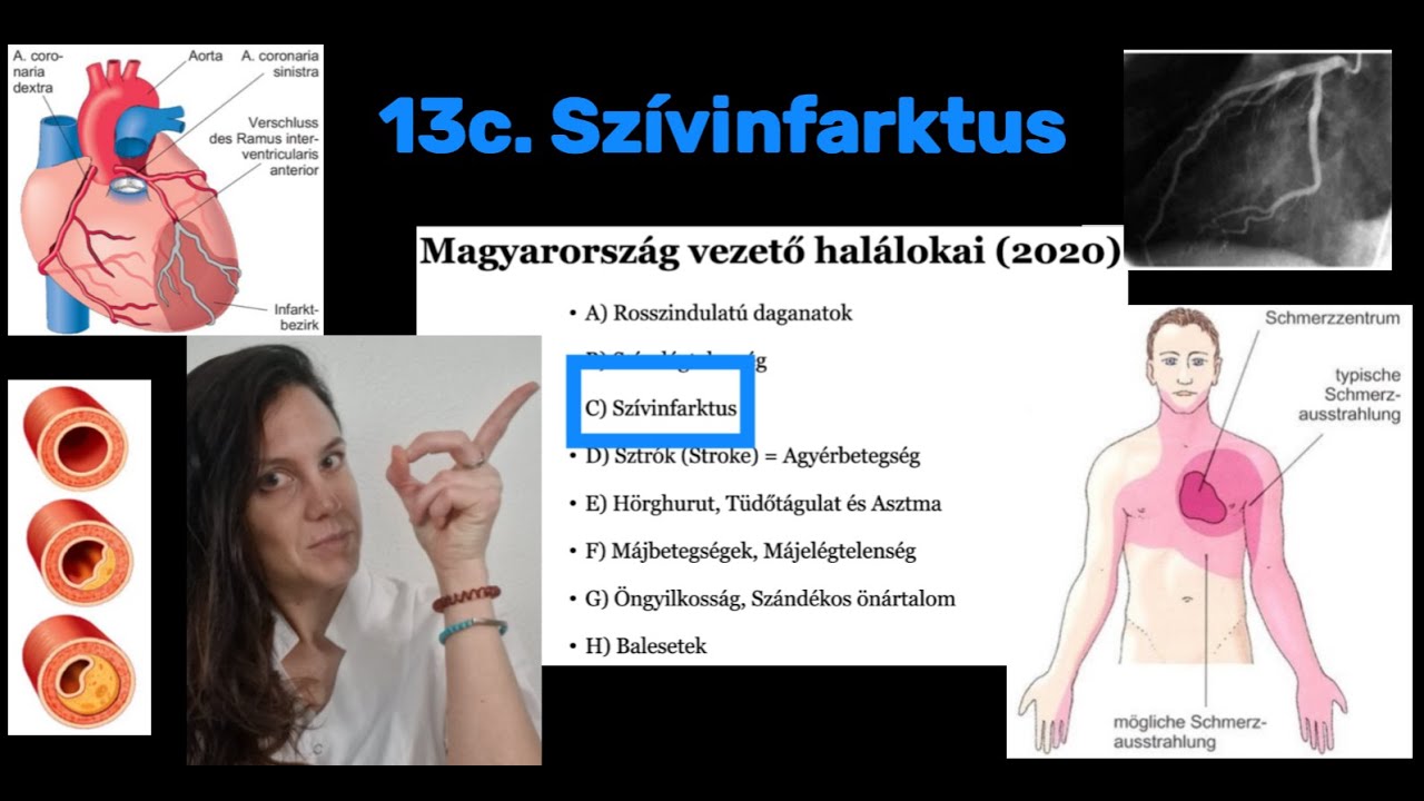 13. M.o. vezető halálokai - 13c. Szívinfarktus