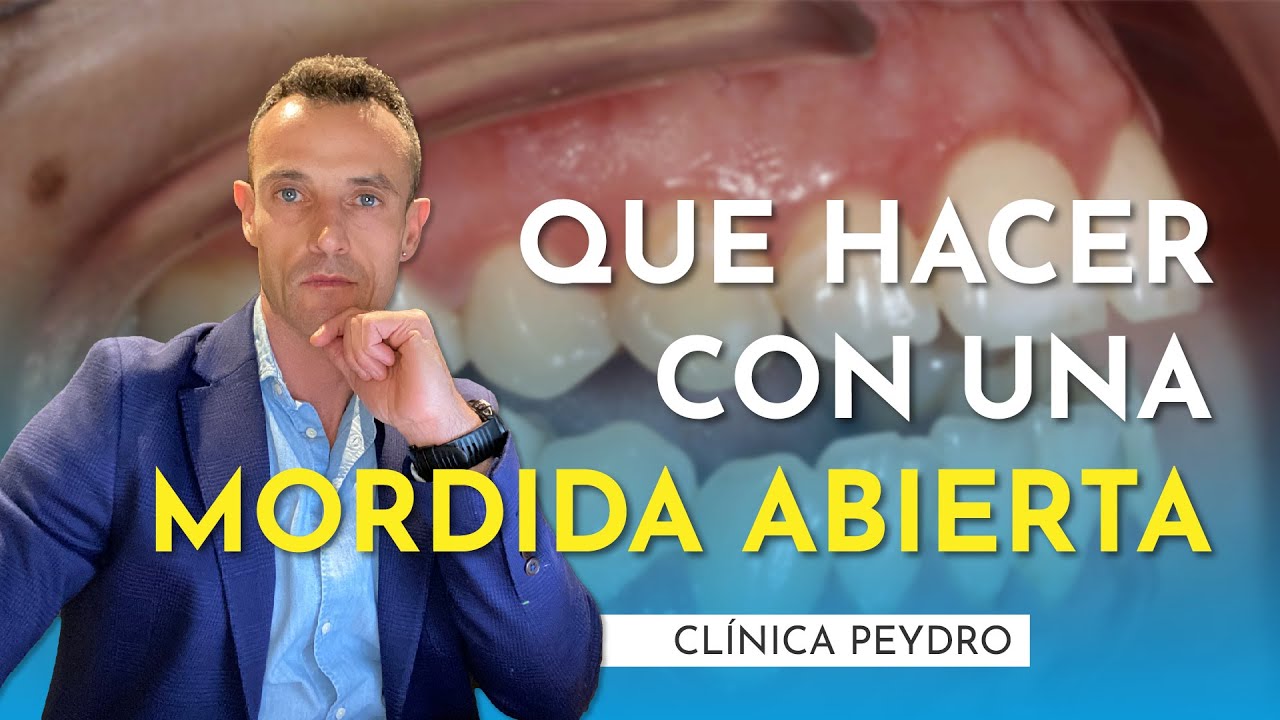 Mordida abierta, ¿es posible solucionarla sin cirugía?