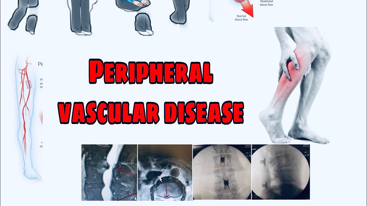 Peripheral arterial dieseas | causes,risk factors,differential daignosis,investigation,management