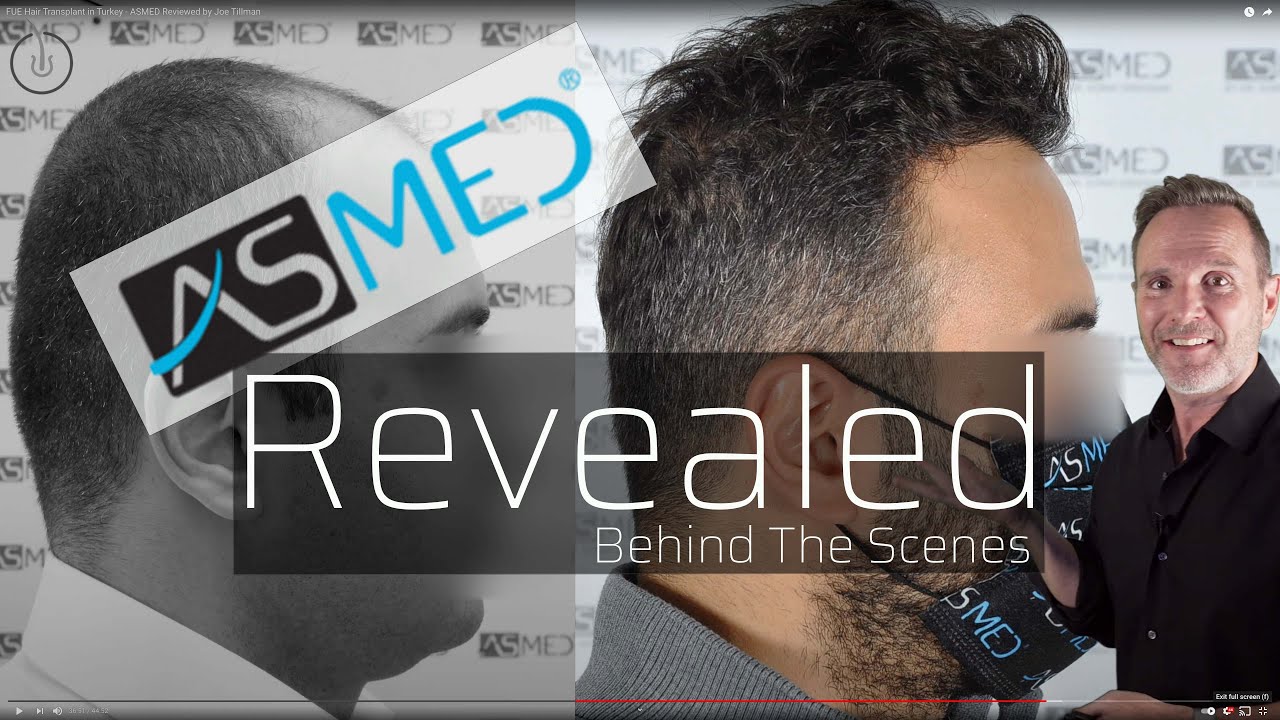 Пересадка волос методом FUE в Турции — обзор ASMED от Джо Тиллмана