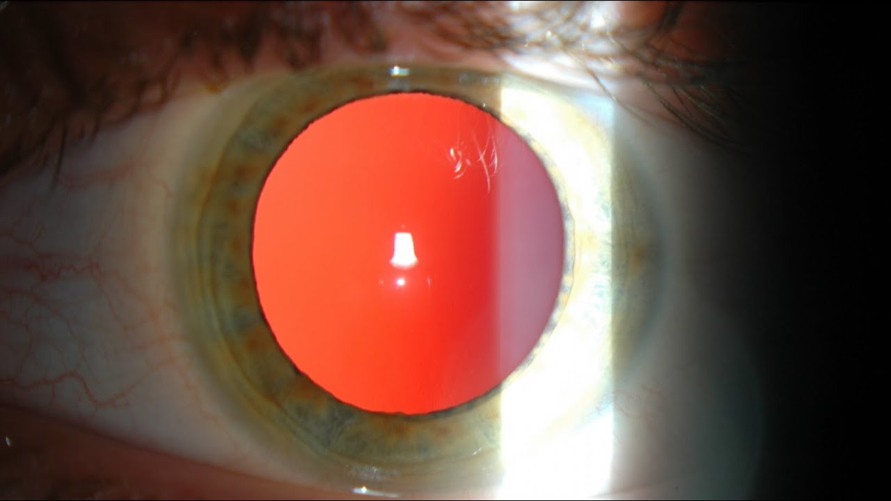 Color de los ojos según la pigmentación del iris y la luz ambiental