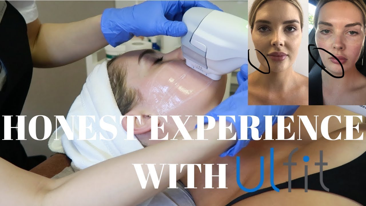 I GOT A FACE LIFT!  | HONEST ULFIT EXPERIENCE