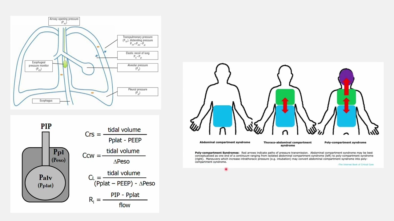 Setting PEEP in ARDS
