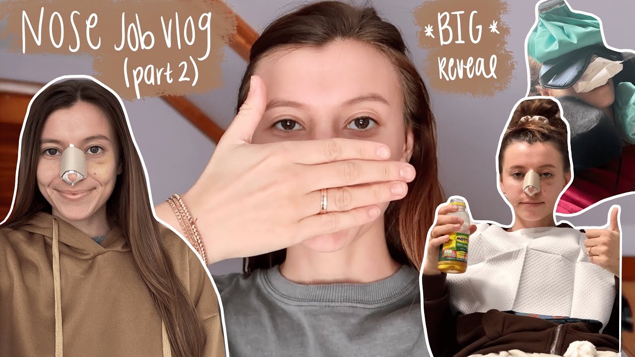 NOSE JOB VLOG part 2: daily recovery experience, splint removal, & big reveal!