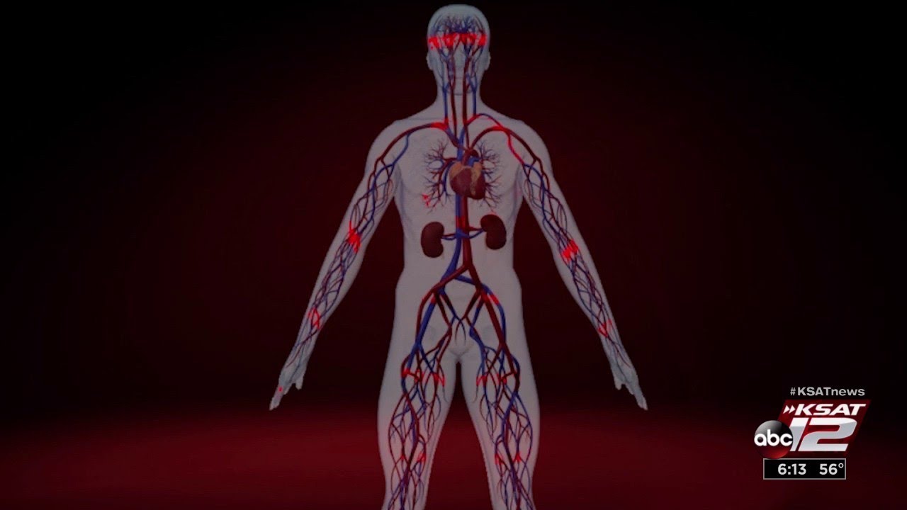Chronic mesenteric ischemia: Not just a stomach ache