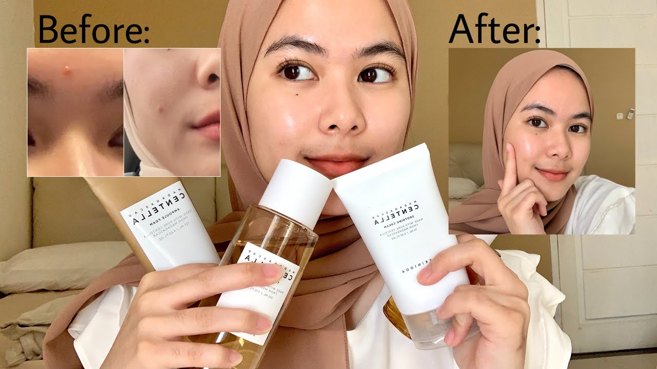 Kandungan dan Produk Skincare untuk Kulit Sensitif & Beruntusan: Skin 1004