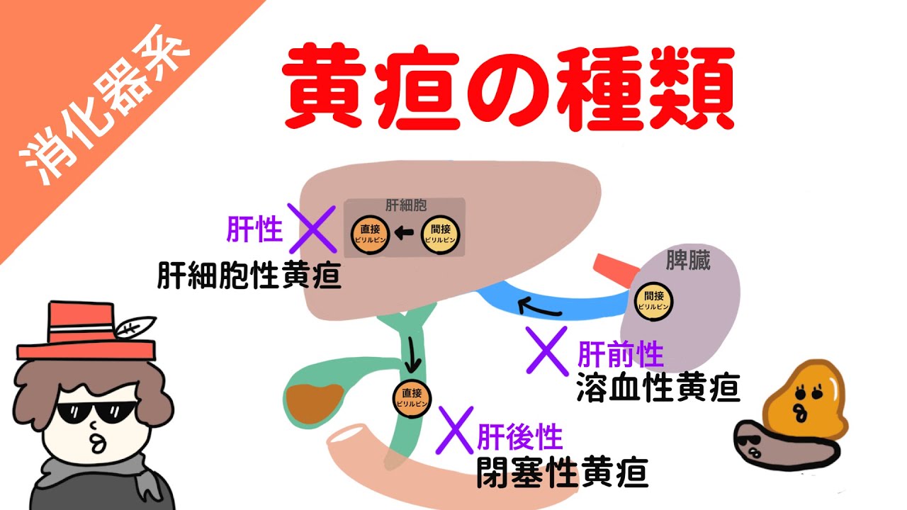 【国試対策】黄疸の種類（溶血性黄疸、肝細胞性黄疸、閉塞性黄疸）