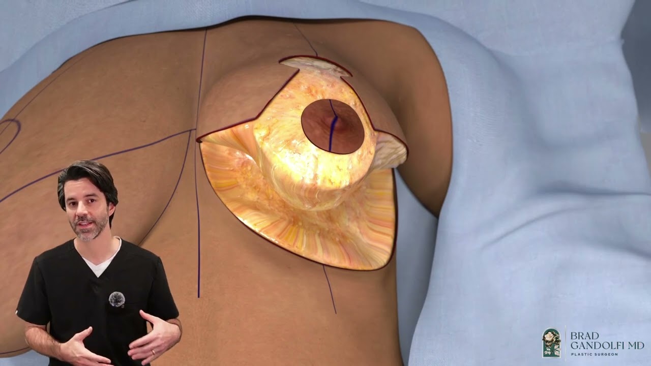 This is How a Breast Reduction is Done | Dr. Brad Gandolfi