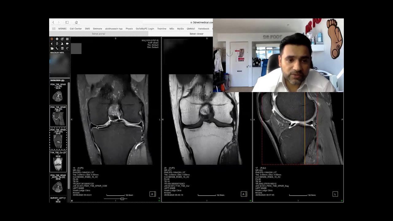 MRI Knee pre Ostenil Knee Injection for Meniscus Tear