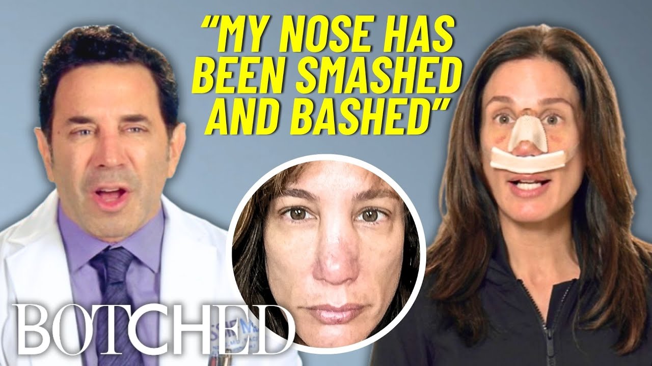 Stacie&rsquo;s Nose Was DESTROYED After 4 Accidents & 14 Surgeries | Botched | E!