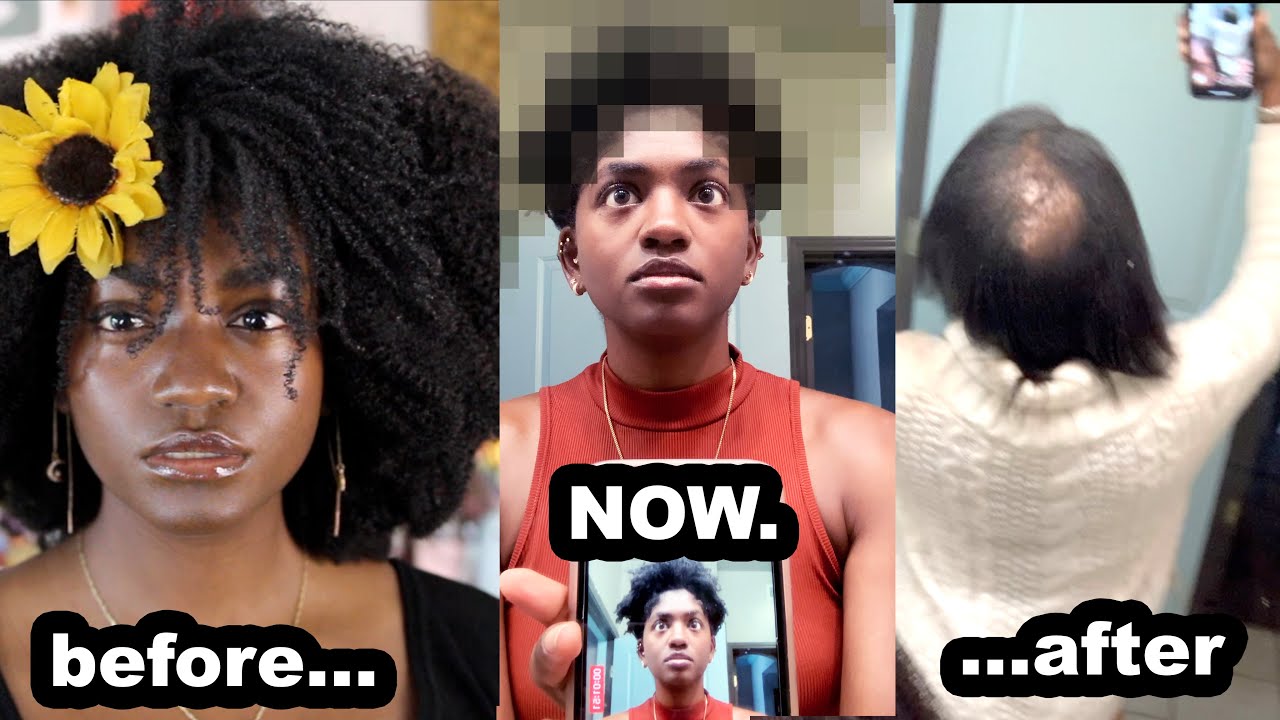 I styled my bald patch for a week... | 4C Natural hair