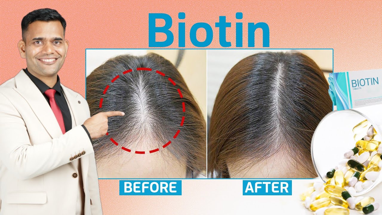 Biotin For Hair Loss, Thinning Hair | Top Biotin Rich Food - Dr. Vivek Joshi
