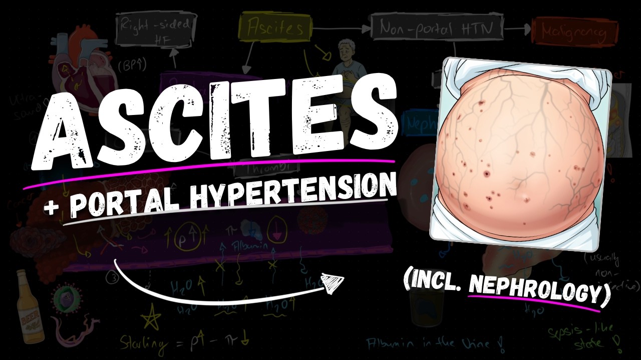 ASCITES made easy! (for Medical Students!)