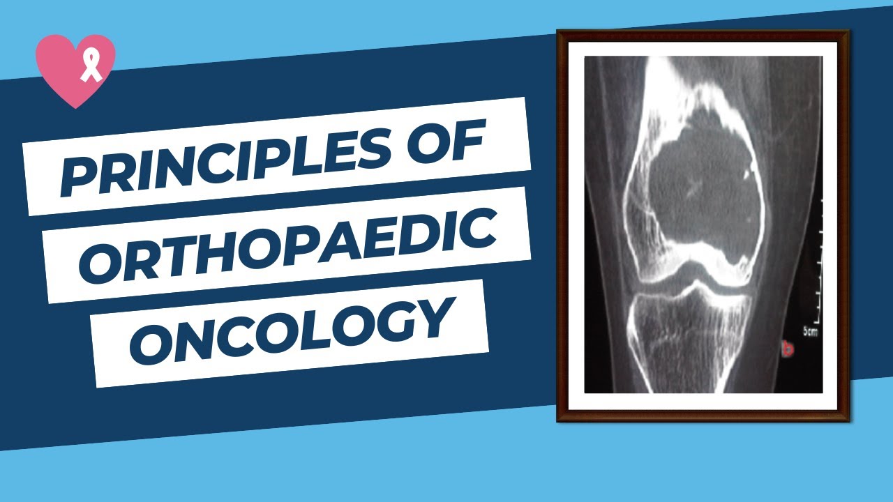 Principles of Orthopaedic Oncology and Bone Tumours for the FRCS Ortho Exam