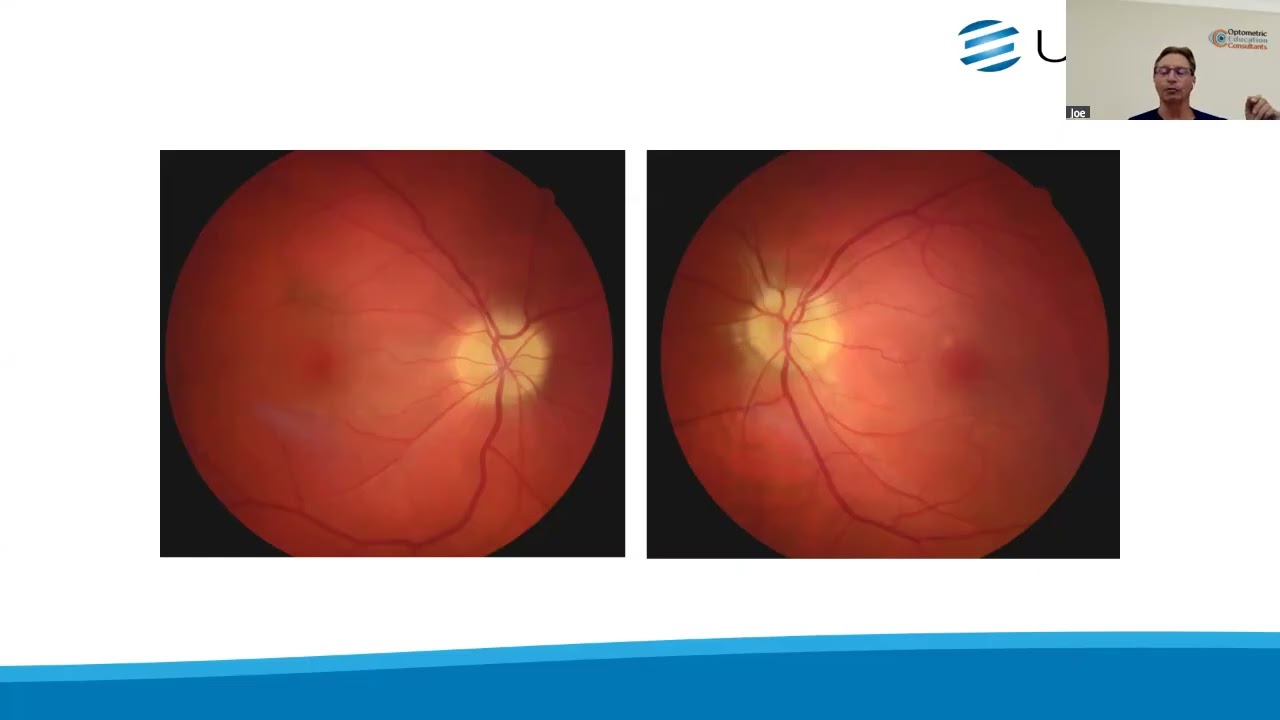 Neuro Ophthalmic Disease Rules That You And Your Patient! Can Live By
