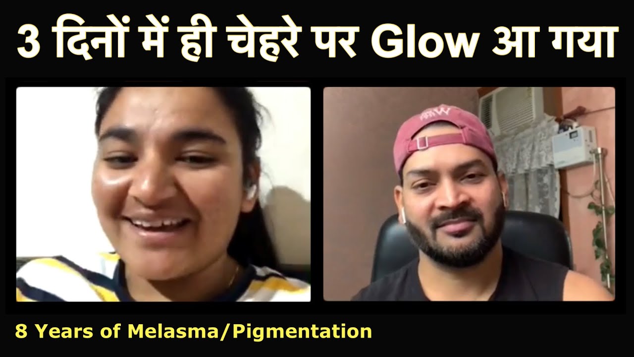 Face is Glowing within 3 days with your Diet. Doctor didn’t have any remedy for Melasma/Pigmentation