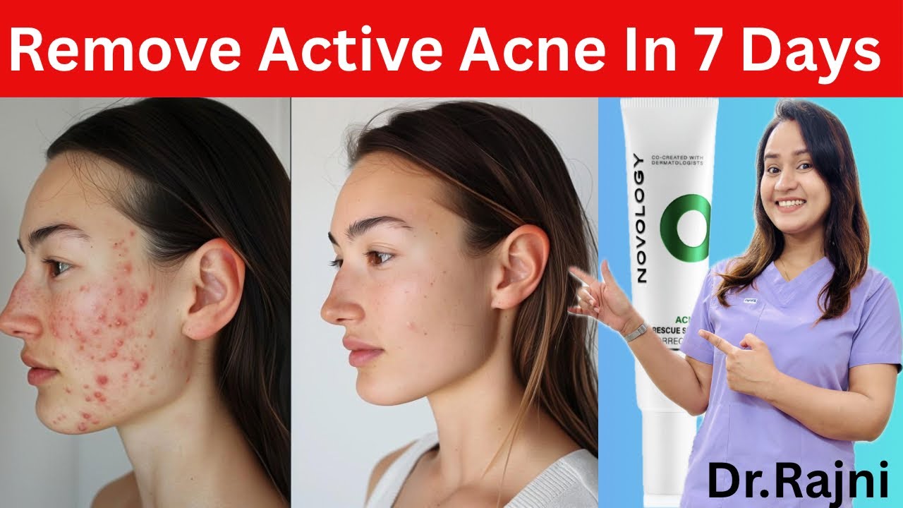 Remove Active Acne & Pimples In 7 Days | Novology Acne Rescue Spot Corrector Cream Review |#novology