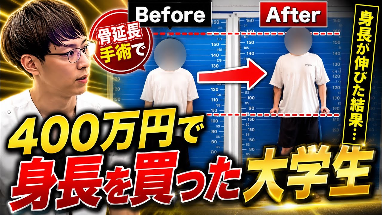 [骨延長手術]400万円で身長を買った大学生の人生が激変しました！