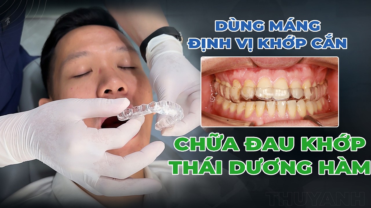 ĐAU KHI ĂN NHAI, ĐAU HÀM BÊN TRÁI DO KHỚP THÁI DƯƠNG HÀM - ĐIỀU TRỊ ĐƠN GIẢN BẰNG MÁNG ĐỊNH VỊ KHỚP