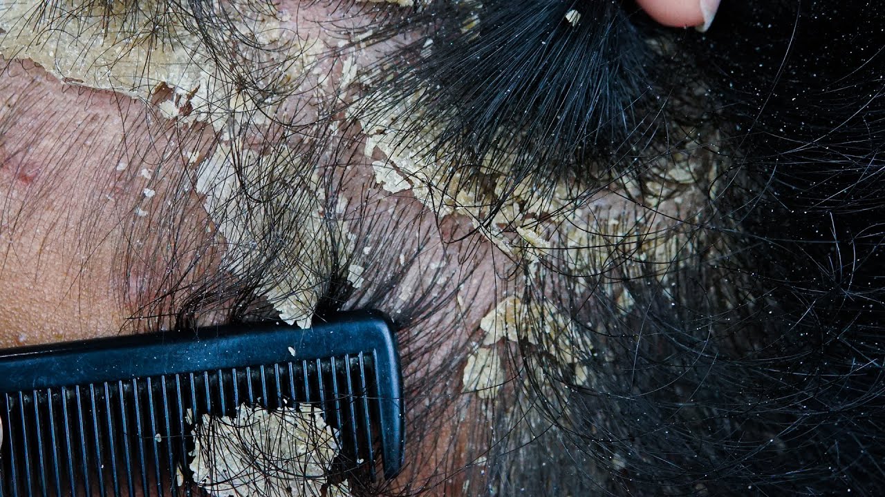 Satisfying Scalp Dandruff Removal: Comb Scratching Big Flakes #DMO3760