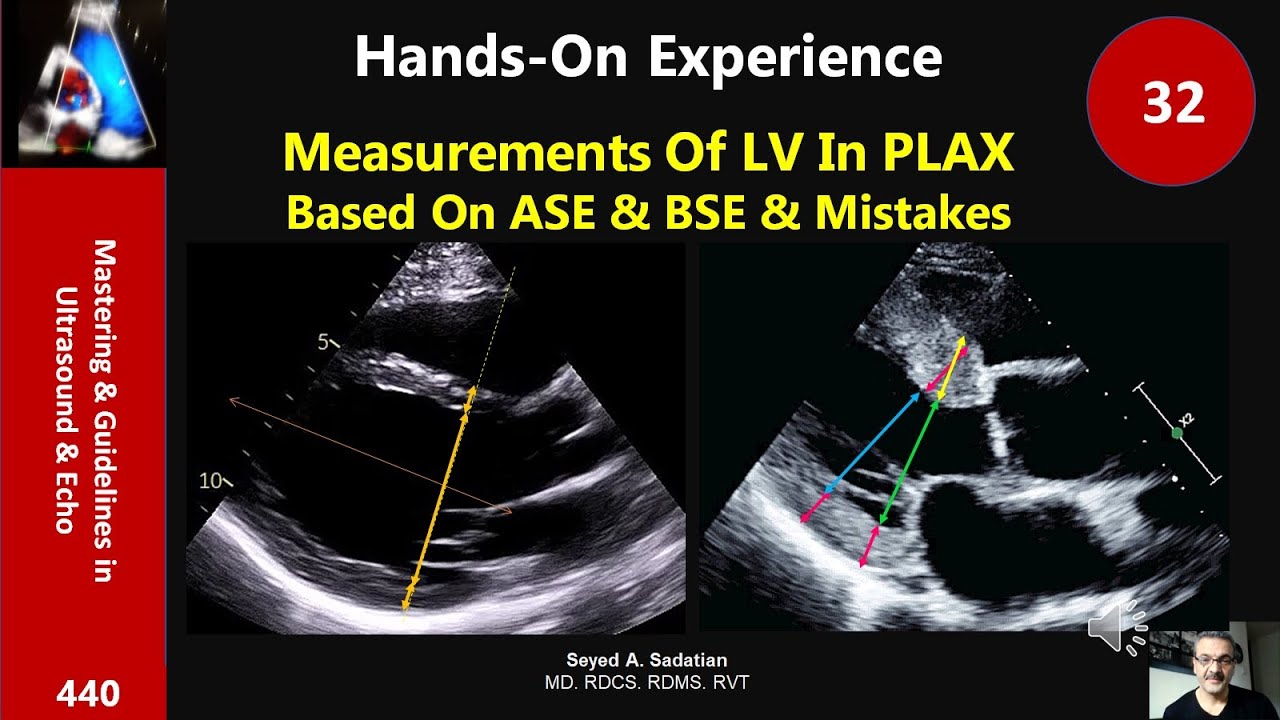 Measurements Of LV In PLAX Based On ASE & BSE & Mistakes: Hands-on 32