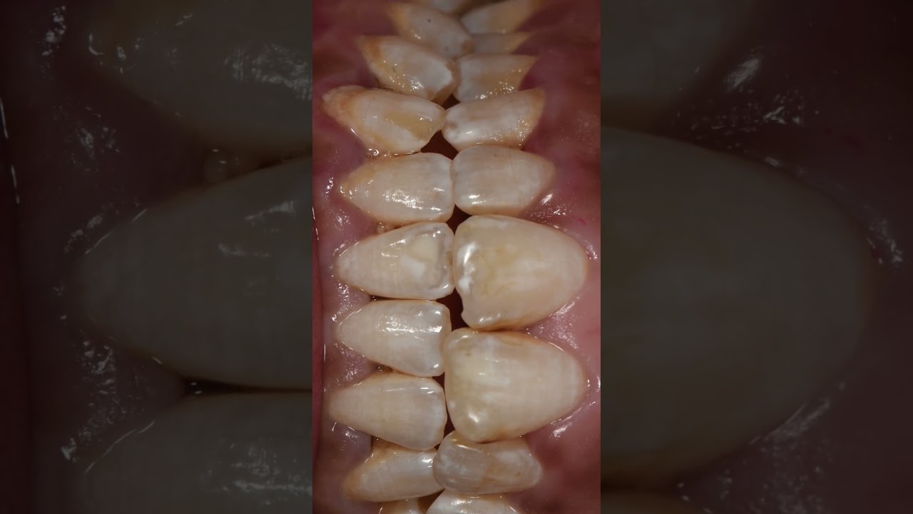 Dental fluorosis removal