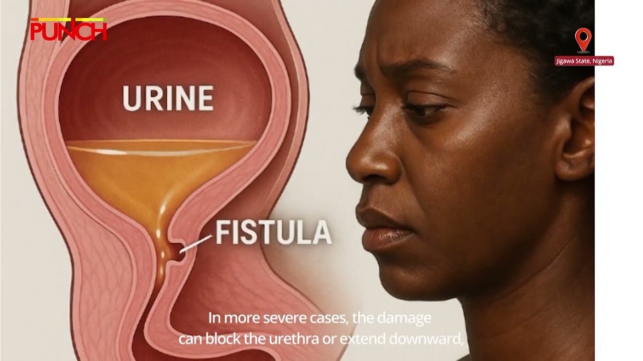 How Jigawa Women Find New Hope After Life-Changing Fistula Repairs| Punch