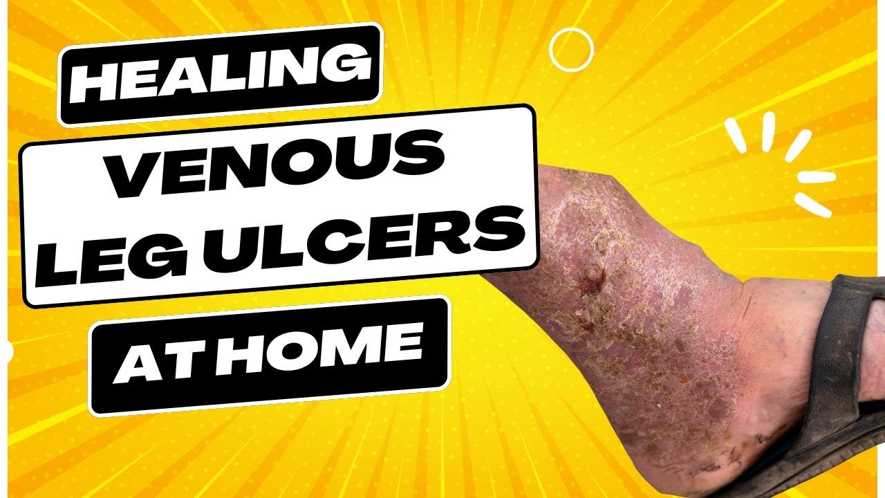 Venous Leg Ulcer Won't Heal? Do This at Home