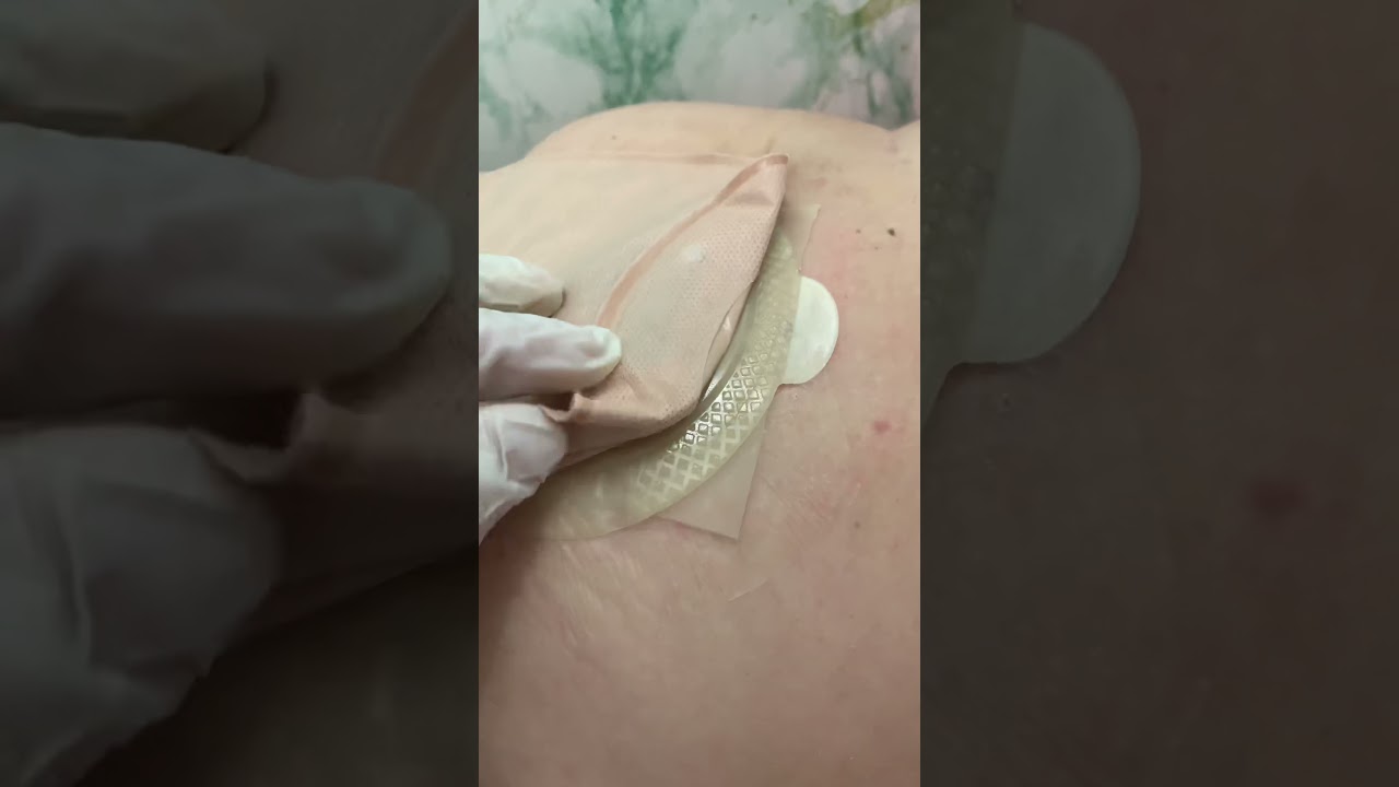 Dicas para fixar melhor a bolsa coletora de colostomia.
