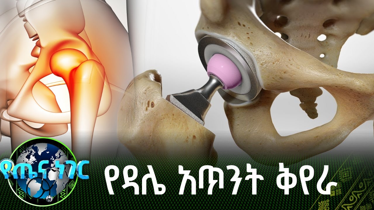 የዳሌ አጥንት ቅየራ | የጤና ነገር