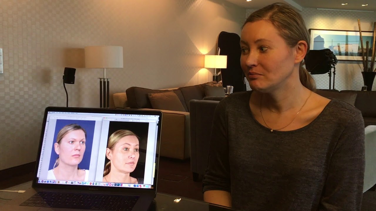 Facial Feminization Surgery Review - Mila, Dr Bart van de Ven reviews