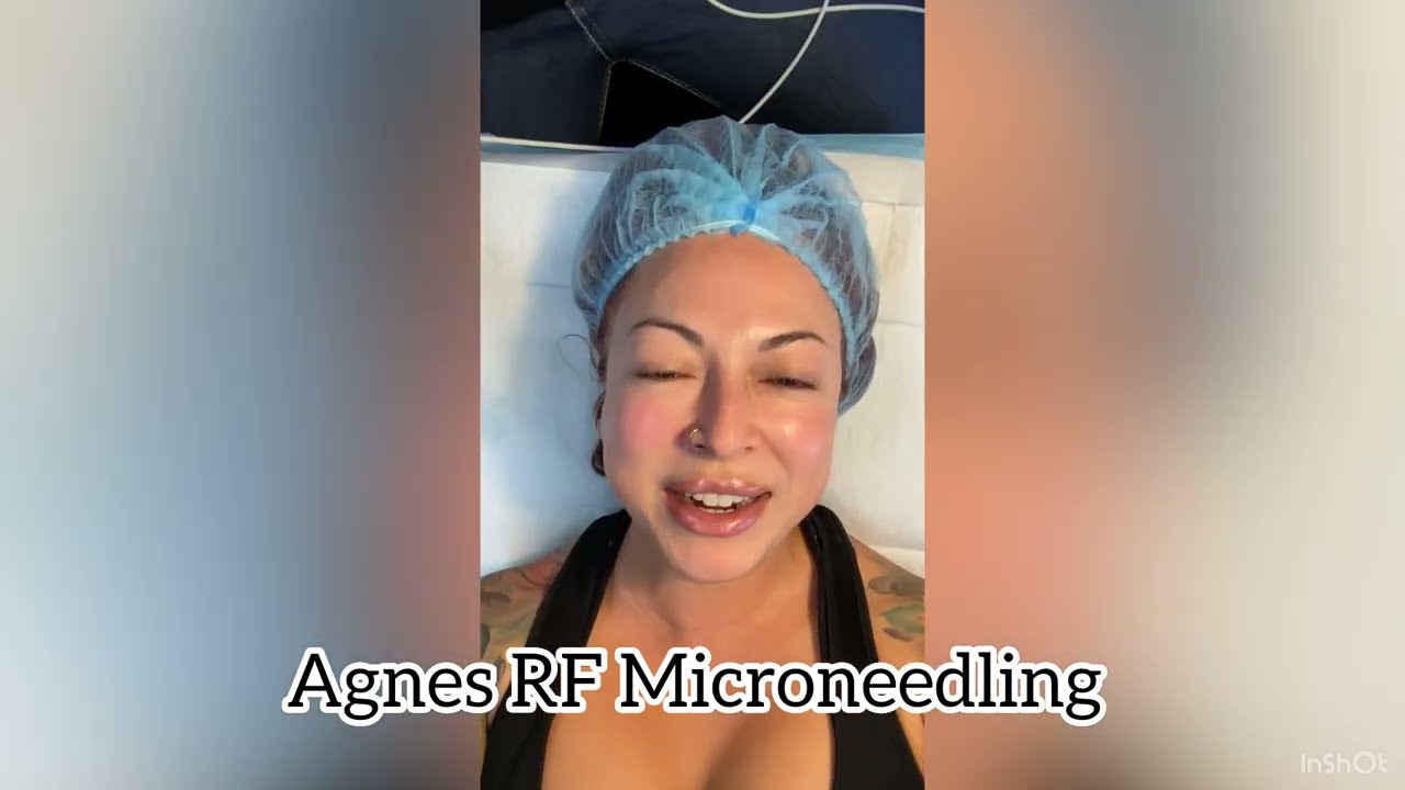 Pore reduction with Agnes RF Microneedling