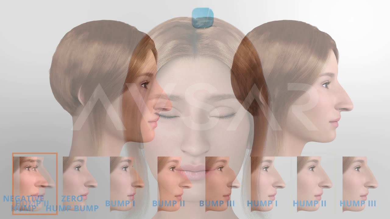 Dr. Yakup Avsar Dorsal Preservation Osteotomy Techniques in Septo-rhinoplasty. Hump classification