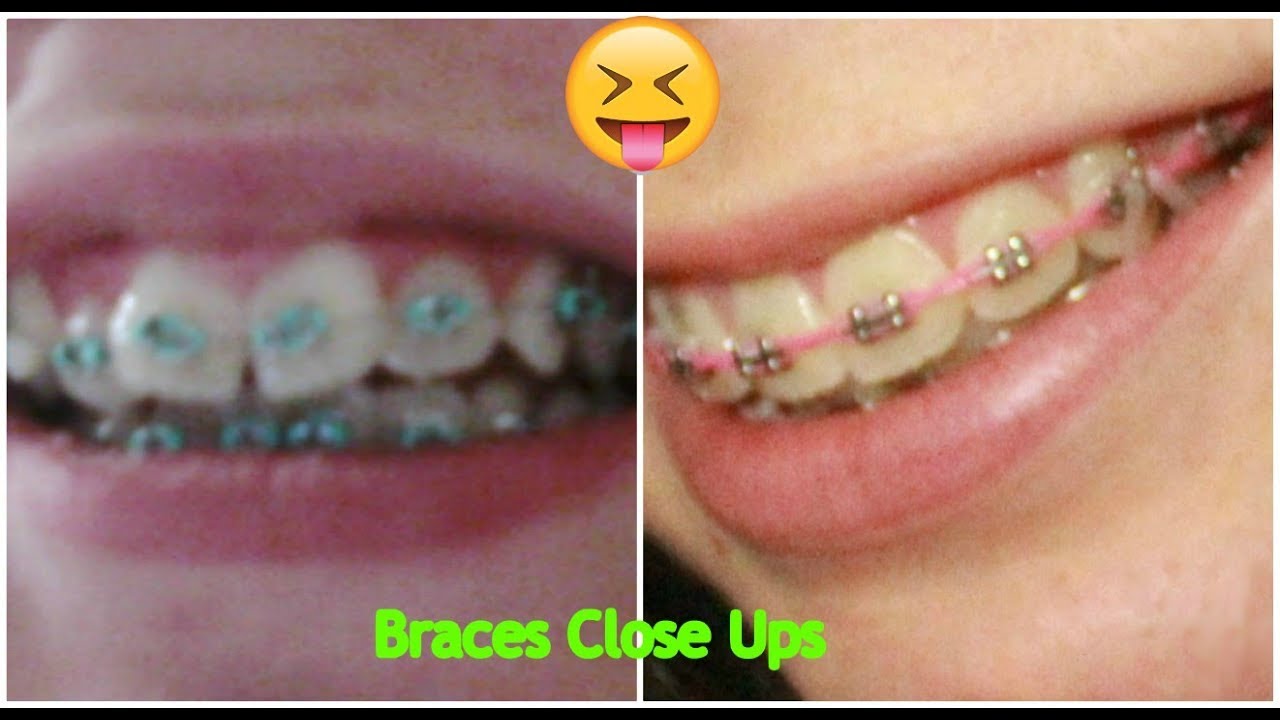Braces Close Ups