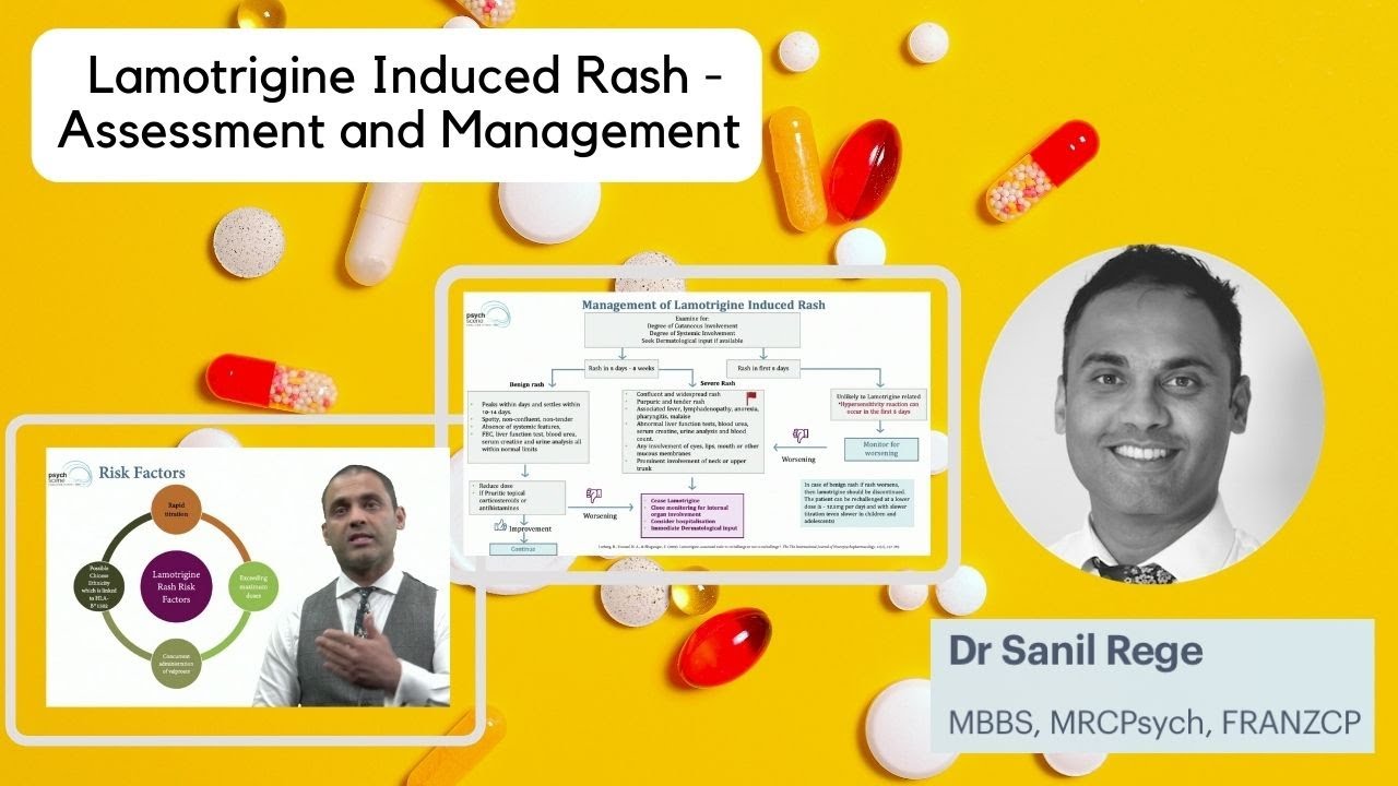 Lamotrigine Induced Rash - Assessment and Management by Dr. Sanil Rege