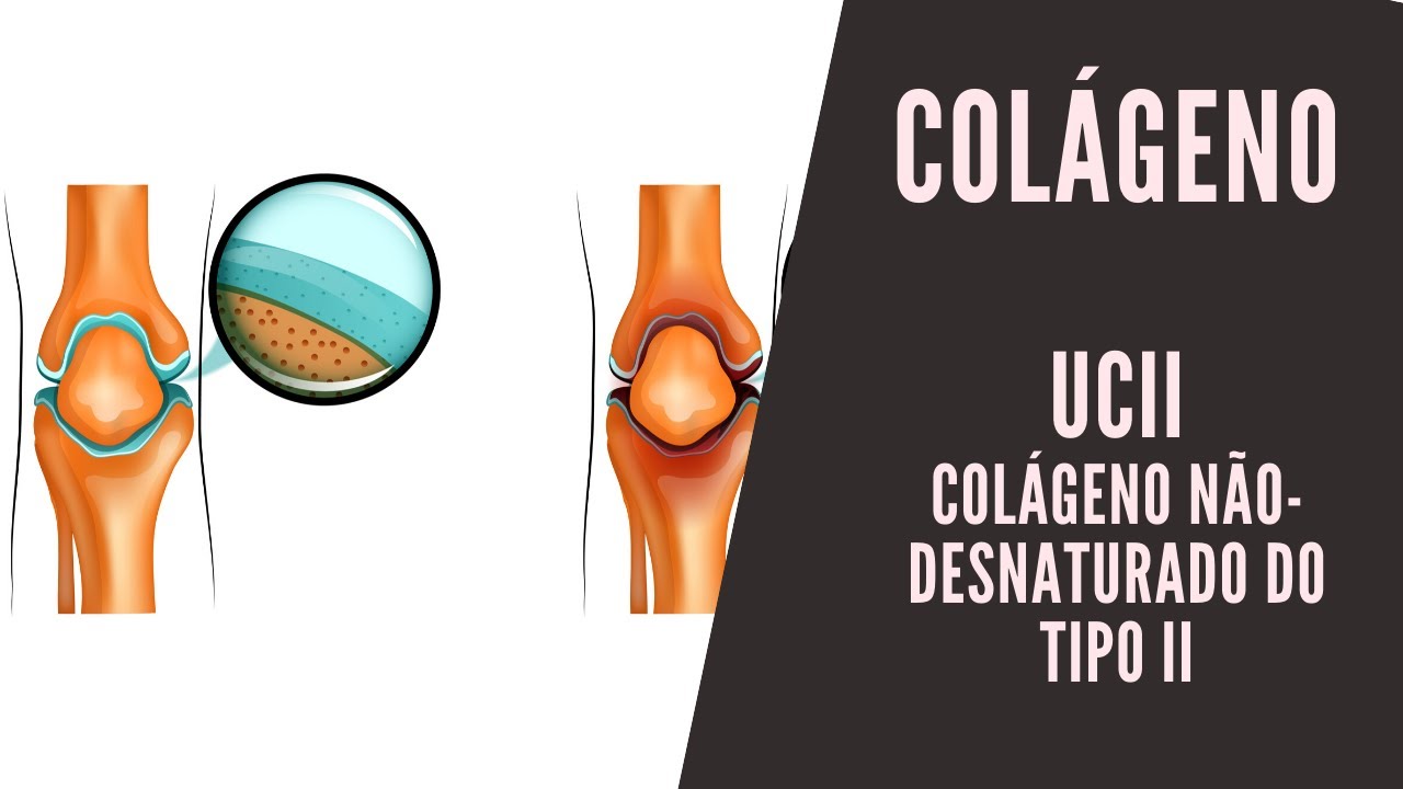 UCII ou B2Cool ou Colágeno não desnaturado do tipo II, você conhece?