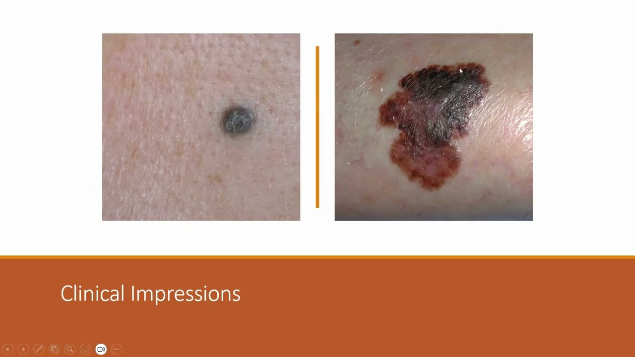 Webinar on Dermatopathology