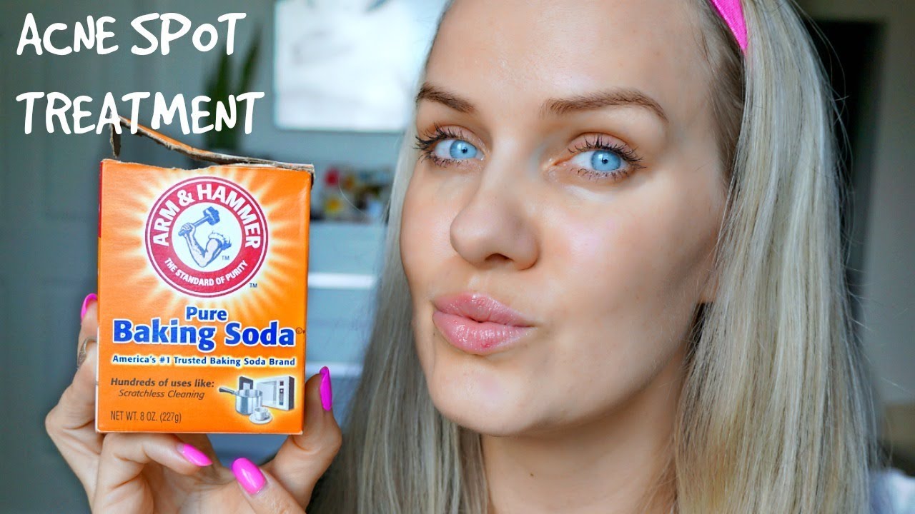 HOW TO GET RID OF ACNE USING BAKING SODA - SPOT TREATMENT IN 5 DAYS