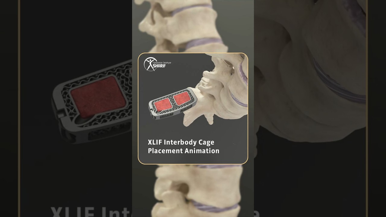 XLIF Interbody Cage Placement Animation