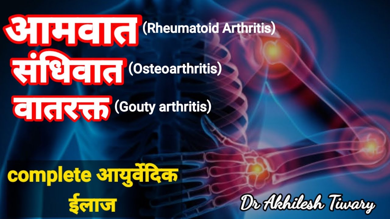 आमवात,संधिवात और वातरक्त का complet आयुर्वेदिक उपचार।संधिशूल का आयुर्वेदिक ईलाज।dr Akhilesh Tiwary।