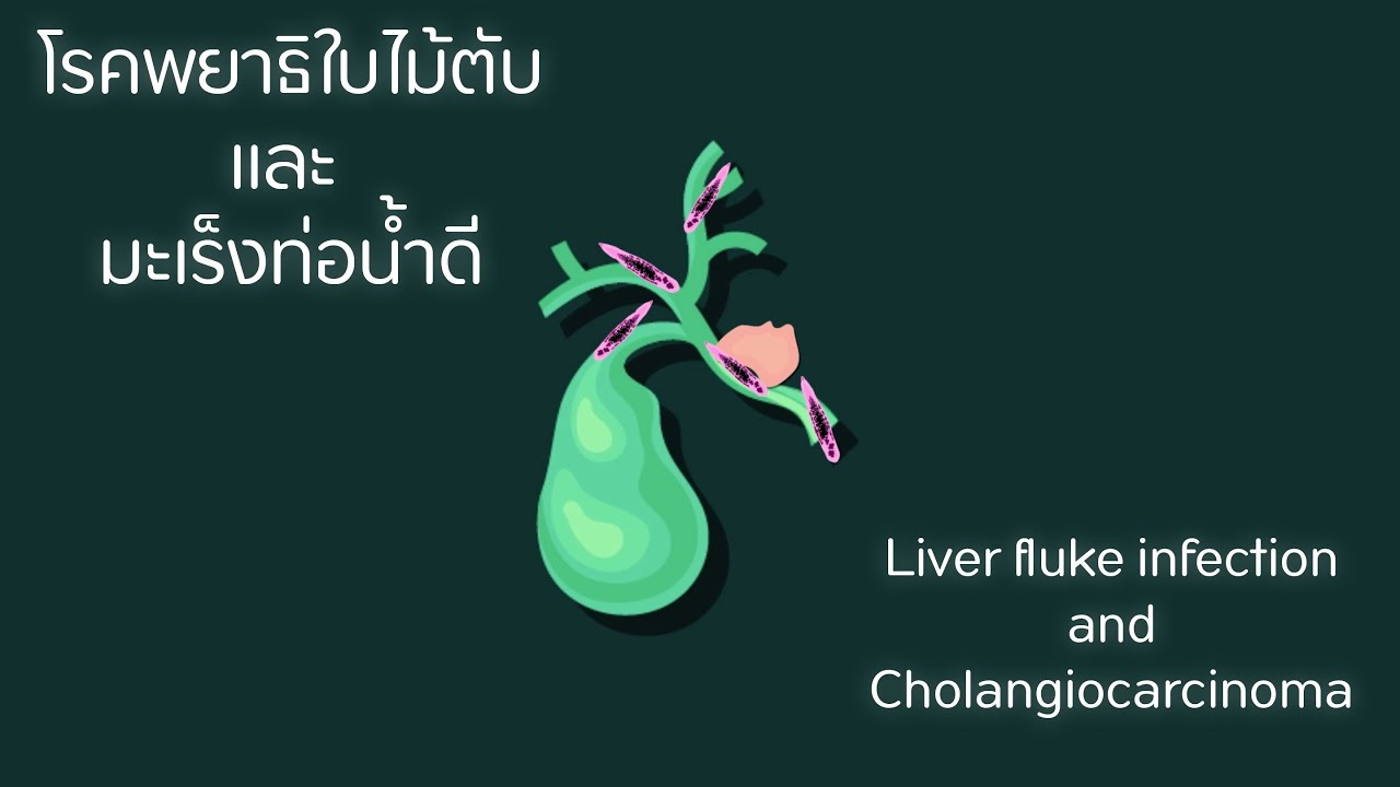 โรคพยาธิใบไม้ตับและมะเร็งท่อน้ำดี [Bile duct cancer] | Opisthorchiasis and Cholangiocarcinoma